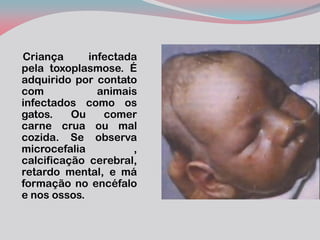 Criança infectada pela toxoplasmose. É adquirido por contato com animais infectados como os gatos. Ou comer carne crua ou mal cozida. Se observa microcefalia , calcificação cerebral, retardo mental, e má formação no encéfalo e nos ossos. 
 