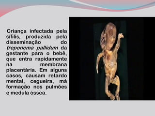Criança infectada pela sífilis, produzida pela disseminação do treponema pallidum da gestante para o bebê, que entra rapidamente na membrana placentária. Em alguns casos, causam retardo mental, cegueira, má formação nos pulmões e medula óssea. 
 