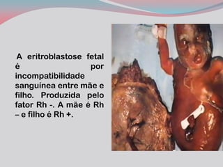 A eritroblastose fetal é por incompatibilidade sanguínea entre mãe e filho. Produzida pelo fator Rh -. A mãe é Rh – e filho é Rh +. 
 