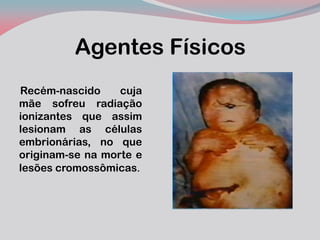 Agentes Físicos 
Recém-nascido cuja mãe sofreu radiação ionizantes que assim lesionam as células embrionárias, no que originam-se na morte e lesões cromossômicas.  