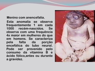 Menino com anencefalia. 
Esta anomalia se observa frequentemente 1 em cada 1000 recém-nascidos. Se observa com uma frequência 4x maior em mulheres do que em homens. Se caracteriza pela falta da porção encefálica do tubo neural. Pode ser prevenido pelo consumo da vitamina B e ácido fólico,antes ou durante a gravidez.  