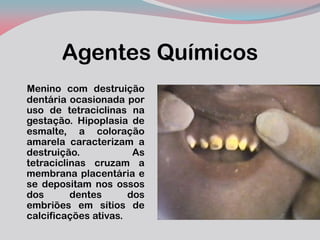 Agentes Químicos 
Menino com destruição dentária ocasionada por uso de tetraciclinas na gestação. Hipoplasia de esmalte, a coloração amarela caracterizam a destruição. As tetraciclinas cruzam a membrana placentária e se depositam nos ossos dos dentes dos embriões em sítios de calcificações ativas.  