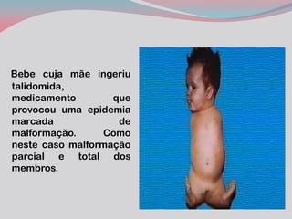 Bebe cuja mãe ingeriu talidomida, medicamento que provocou uma epidemia marcada de malformação. Como neste caso malformação parcial e total dos membros.  