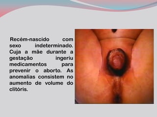 Recém-nascido com sexo indeterminado. Cuja a mãe durante a gestação ingeriu medicamentos para prevenir o aborto. As anomalias consistem no aumento de volume do clitóris.  
