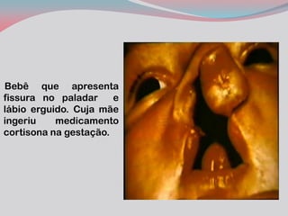 Bebê que apresenta fissura no paladar e lábio erguido. Cuja mãe ingeriu medicamento cortisona na gestação.  