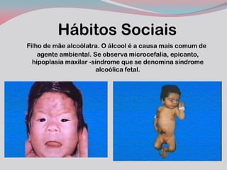 Hábitos Sociais 
Filho de mãe alcoólatra. O álcool é a causa mais comum de agente ambiental. Se observa microcefalia, epicanto, hipoplasia maxilar -síndrome que se denomina síndrome alcoólica fetal.  