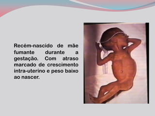 Recém-nascido de mãe fumante durante a gestação. Com atraso marcado de crescimento intra-uterino e peso baixo ao nascer.  