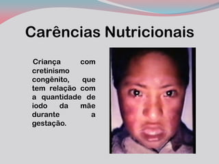 Carências Nutricionais 
Criança com cretinismo congênito, que tem relação com a quantidade de iodo da mãe durante a gestação.  