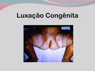 Luxação Congênita  