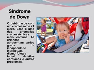 Síndrome de Down 
O bebê nasce com um cromossomo 21 extra. Essa é uma das anomalias cromossômicas mais comuns. As crianças apresentam vários graus de incapacidade intelectual, dismorfologia facial, defeitos cardíacos e outros problemas.  