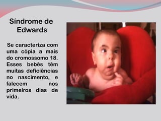 Síndrome de Edwards 
Se caracteriza com uma cópia a mais do cromossomo 18. Esses bebês têm muitas deficiências no nascimento, e falecem nos primeiros dias de vida. 
 