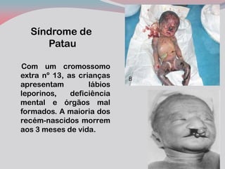 Síndrome de Patau 
Com um cromossomo extra nº 13, as crianças apresentam lábios leporinos, deficiência mental e órgãos mal formados. A maioria dos recém-nascidos morrem aos 3 meses de vida. 
 