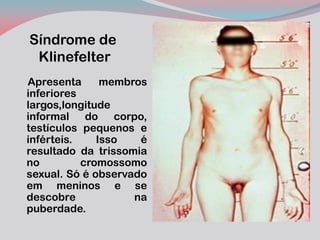 Síndrome de Klinefelter 
Apresenta membros inferiores largos,longitude informal do corpo, testículos pequenos e inférteis. Isso é resultado da trissomia no cromossomo sexual. Só é observado em meninos e se descobre na puberdade.  