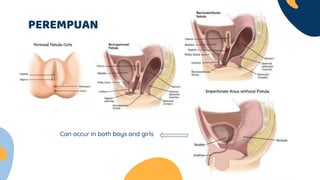 PEREMPUAN
Can occur in both boys and girls
 