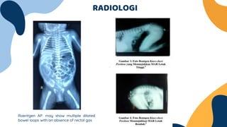 RADIOLOGI
Roentgen AP: may show multiple dilated
bowel loops with an absence of rectal gas
 
