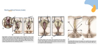 Rectourethral fistula (male)
 
