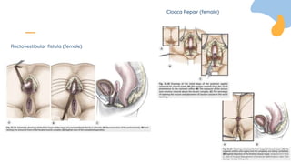 Rectovestibular fistula (female)
Cloaca Repair (female)
 