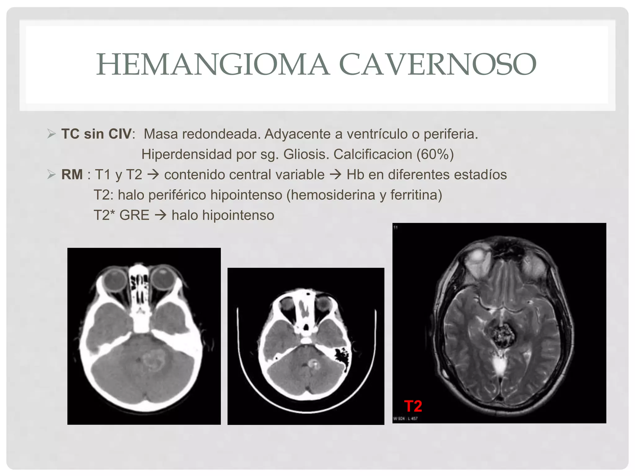Malformaciones vasculares cerebrales | PPTX