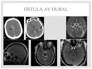 Malformaciones vasculares cerebrales | PPTX