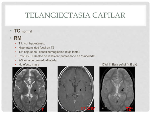 Malformaciones vasculares cerebrales | PPTX