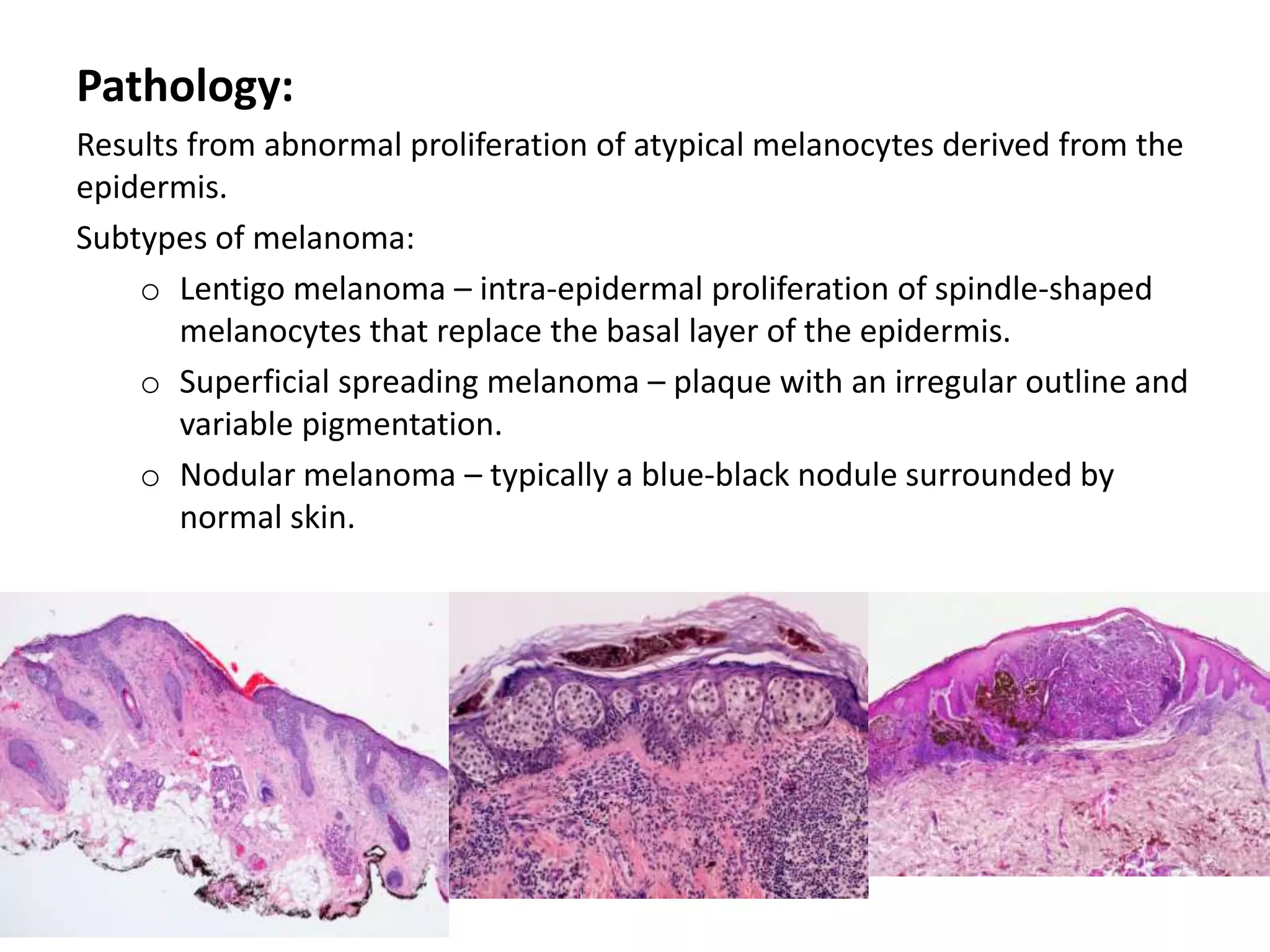 Malignant melanoma of the Eyelid | PPTX