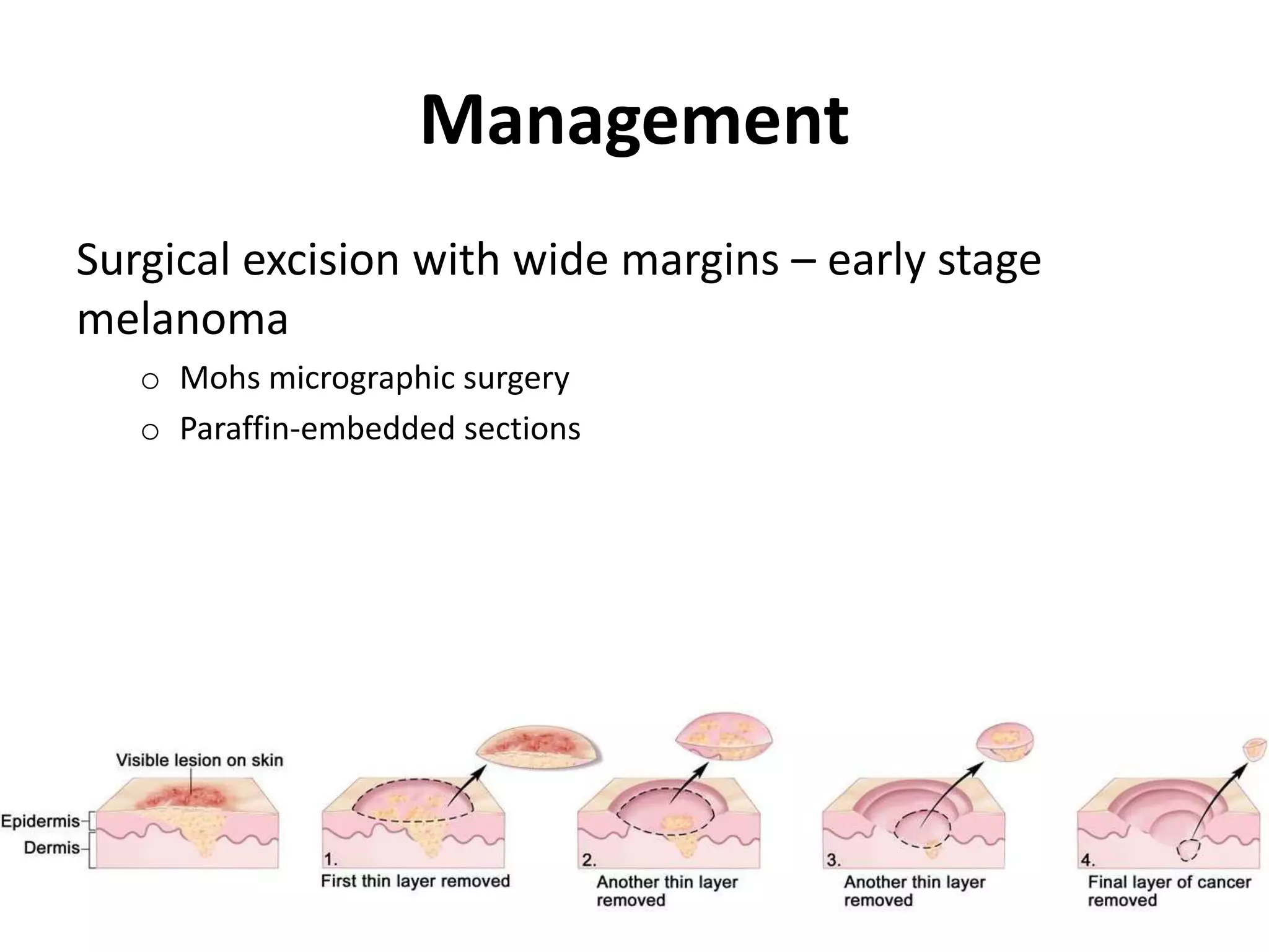 Malignant melanoma of the Eyelid | PPTX