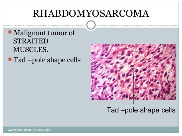 malignancy of connective tissue Malignant Tumors of Connective Tissue-V / dental implant courses by I… malignancy of connective tissue Malignant Tumors of Connective Tissue-V / dental implant courses by I…