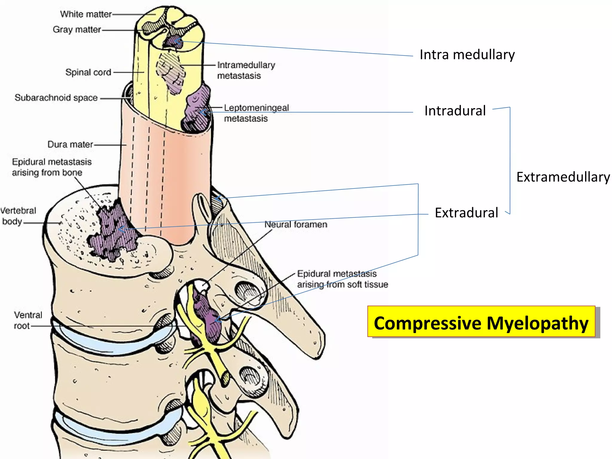 Maliganant spinal cord compression main | PPT