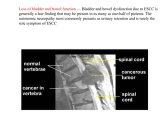Loss of bladder and bowel function — Bladder and bowel dysfunction due to ESCC is
generally a late finding that may be present in as many as one-half of patients. The
autonomic neuropathy most commonly presents as urinary retention and is rarely the
sole symptom of ESCC

 