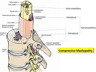 Intra medullary
Intradural

Extramedullary
Extradural

Compressive Myelopathy
Compressive Myelopathy

 