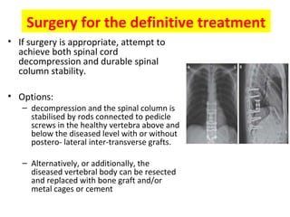 Surgery for the definitive treatment
• If surgery is appropriate, attempt to
achieve both spinal cord
decompression and durable spinal
column stability.
• Options:

– decompression and the spinal column is
stabilised by rods connected to pedicle
screws in the healthy vertebra above and
below the diseased level with or without
postero- lateral inter-transverse grafts.
– Alternatively, or additionally, the
diseased vertebral body can be resected
and replaced with bone graft and/or
metal cages or cement

 