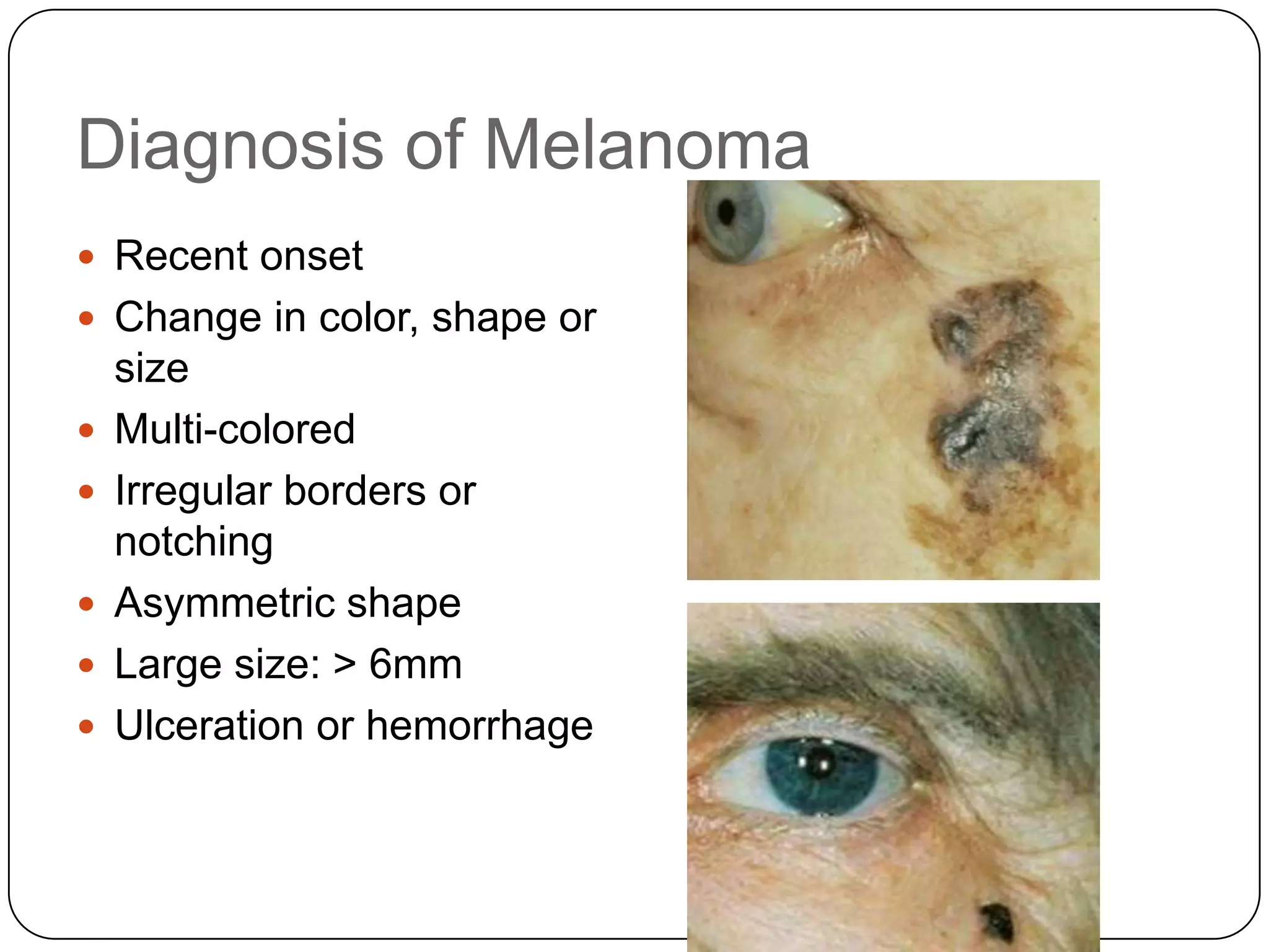 Diagnosis of Melanoma
 Recent onset
 Change in color, shape or
    size
   Multi-colored
   Irregular borders or
    notching
   Asymmetric shape
   Large size: > 6mm
   Ulceration or hemorrhage
 