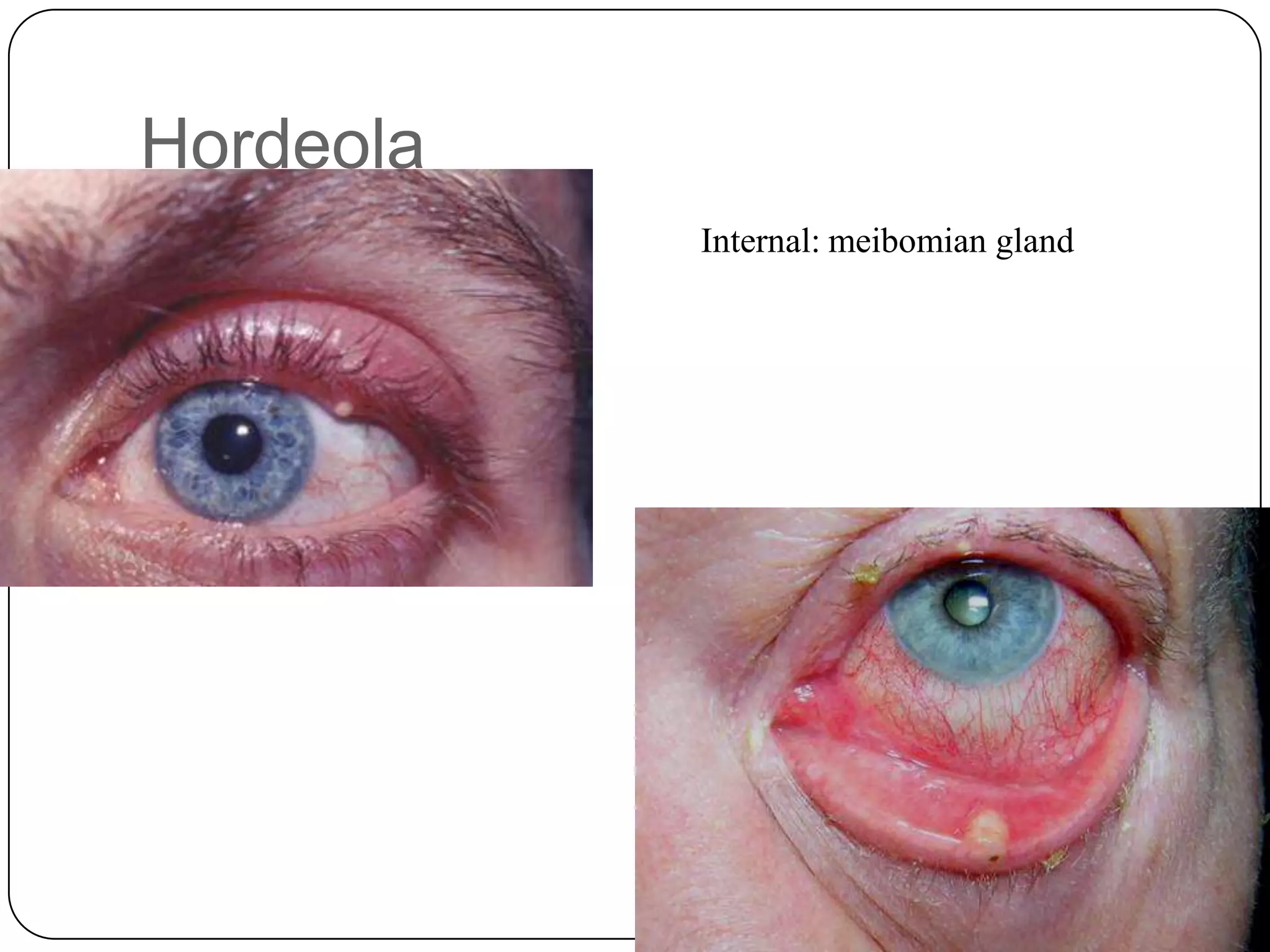 Hordeola
           Internal: meibomian gland
 