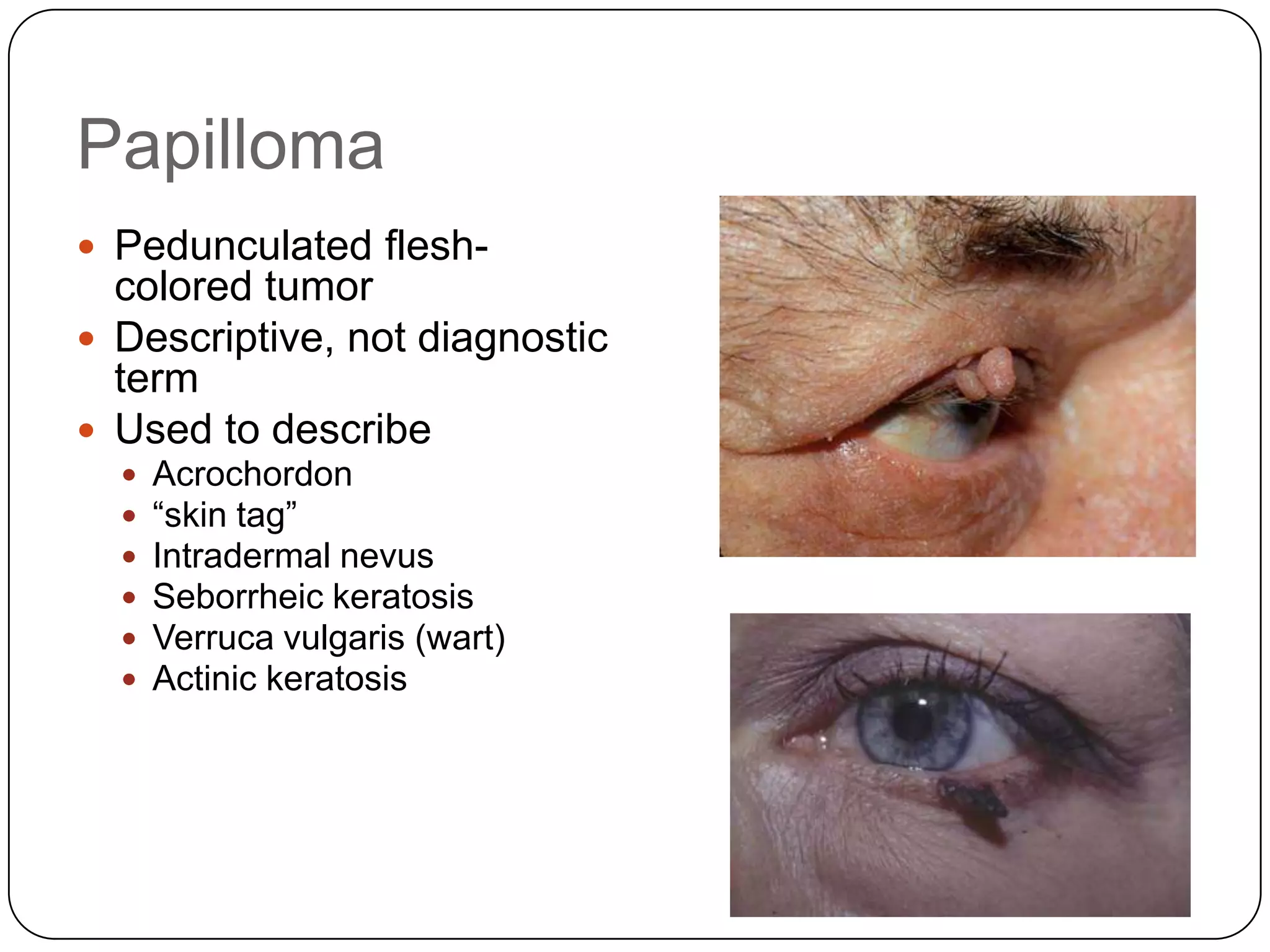 Papilloma
 Pedunculated flesh-
  colored tumor
 Descriptive, not diagnostic
  term
 Used to describe
     Acrochordon
     “skin tag”
     Intradermal nevus
     Seborrheic keratosis
     Verruca vulgaris (wart)
     Actinic keratosis
 