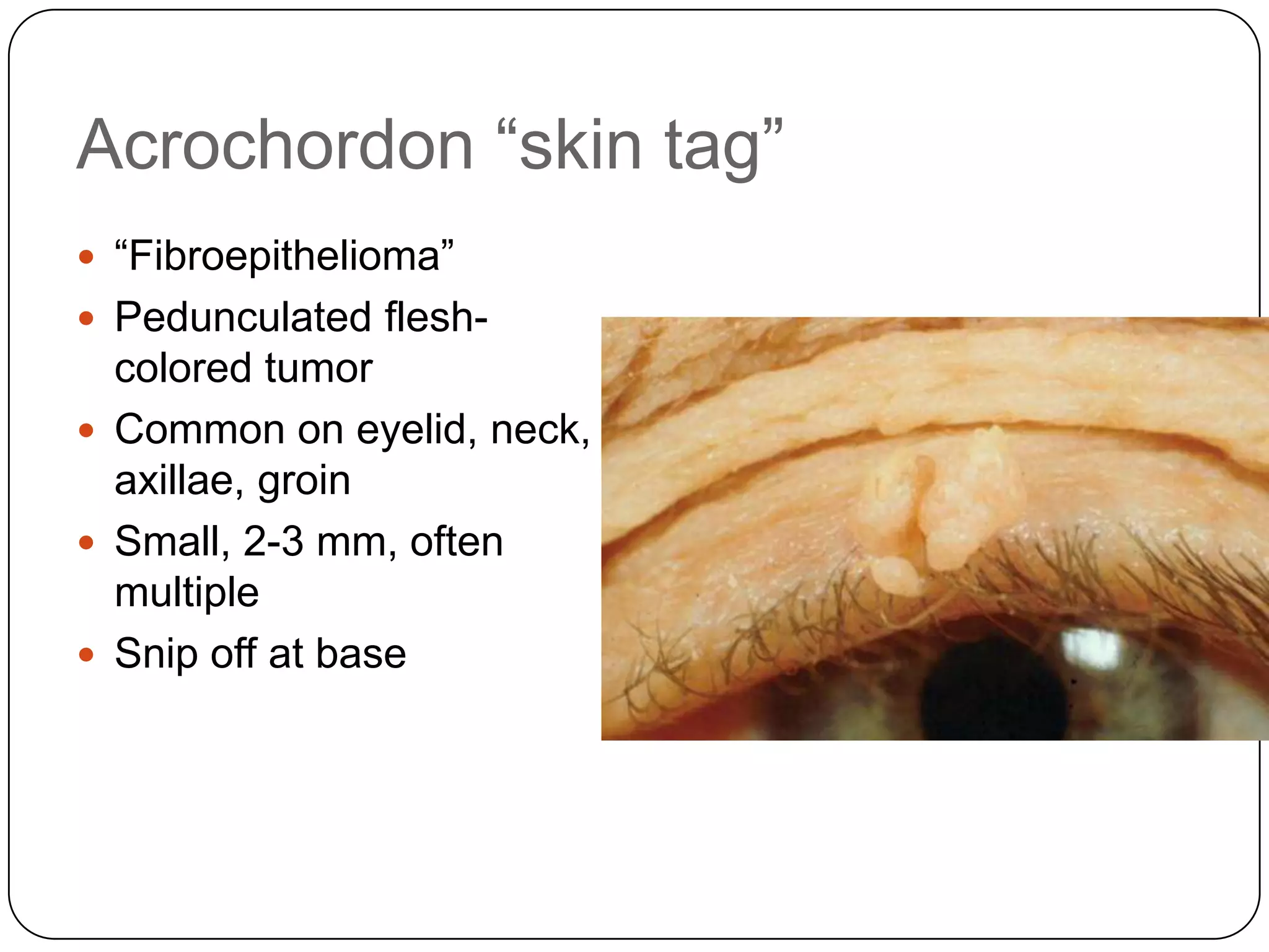 Acrochordon “skin tag”
 “Fibroepithelioma”
 Pedunculated flesh-
  colored tumor
 Common on eyelid, neck,
  axillae, groin
 Small, 2-3 mm, often
  multiple
 Snip off at base
 