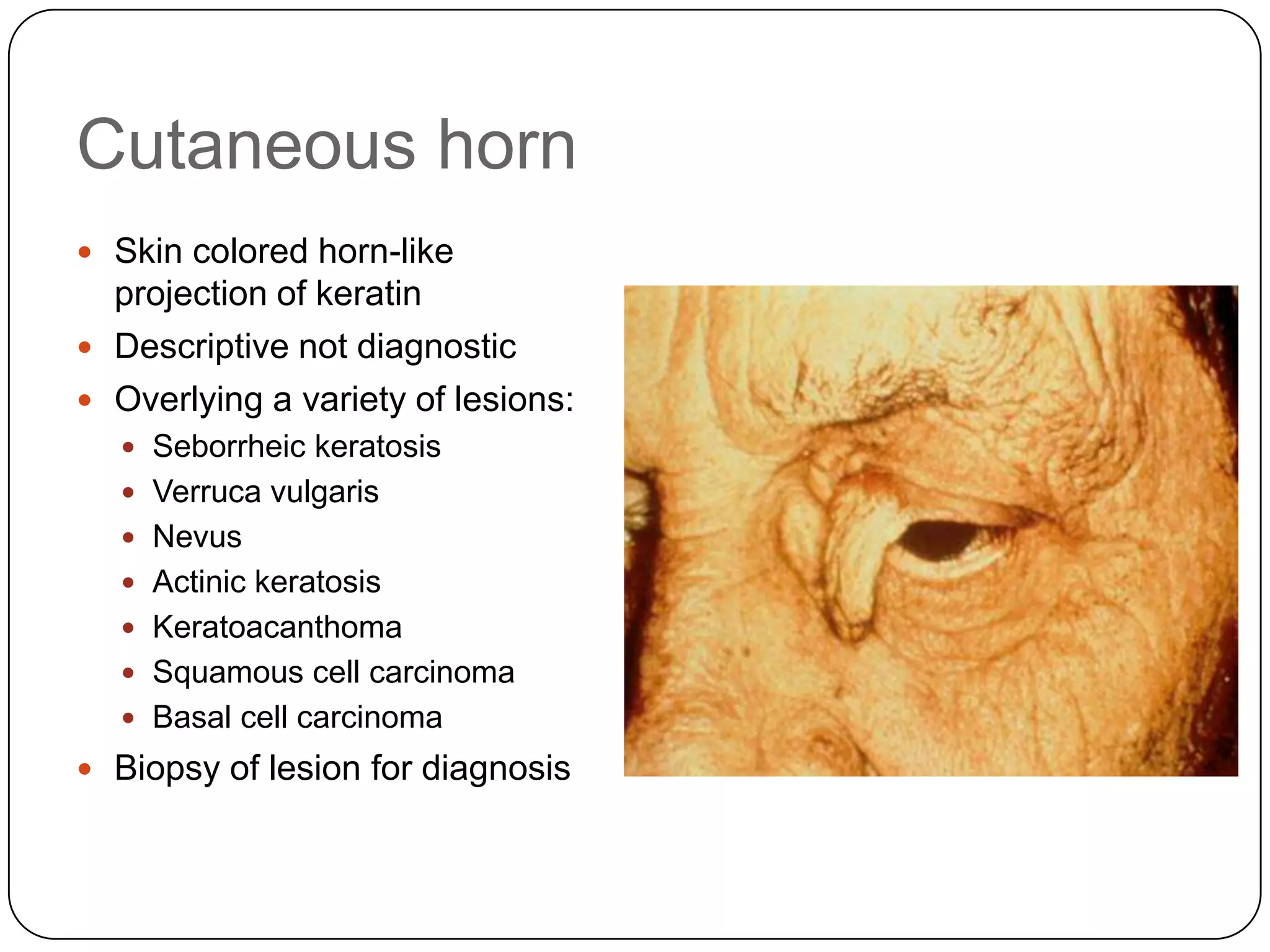 Cutaneous horn
 Skin colored horn-like
  projection of keratin
 Descriptive not diagnostic
 Overlying a variety of lesions:
   Seborrheic keratosis
   Verruca vulgaris
   Nevus
   Actinic keratosis
   Keratoacanthoma
   Squamous cell carcinoma
   Basal cell carcinoma
 Biopsy of lesion for diagnosis
 