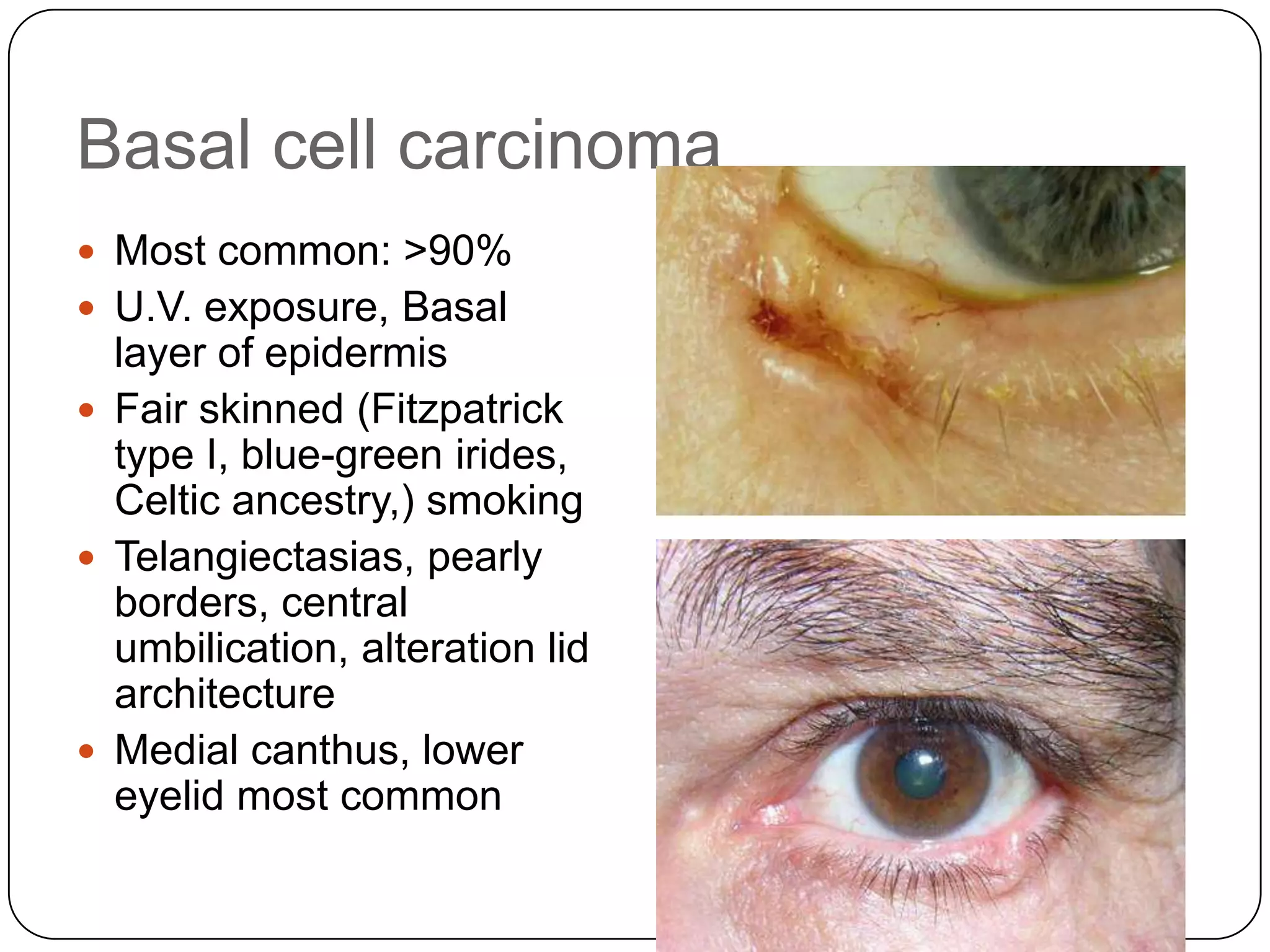 Basal cell carcinoma
 Most common: >90%
 U.V. exposure, Basal
  layer of epidermis
 Fair skinned (Fitzpatrick
  type I, blue-green irides,
  Celtic ancestry,) smoking
 Telangiectasias, pearly
  borders, central
  umbilication, alteration lid
  architecture
 Medial canthus, lower
  eyelid most common
 