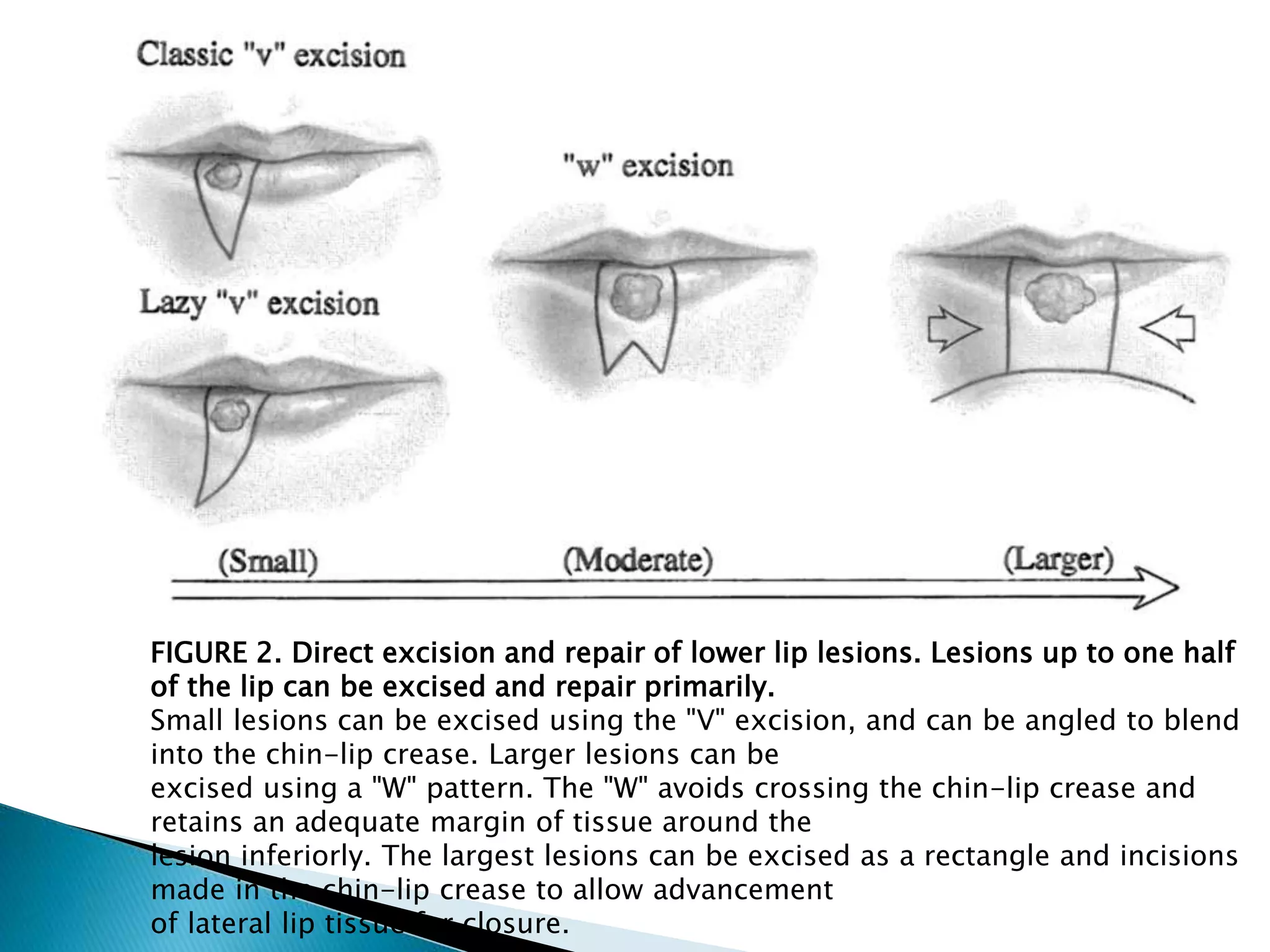 Malignancy of lip | PPTX