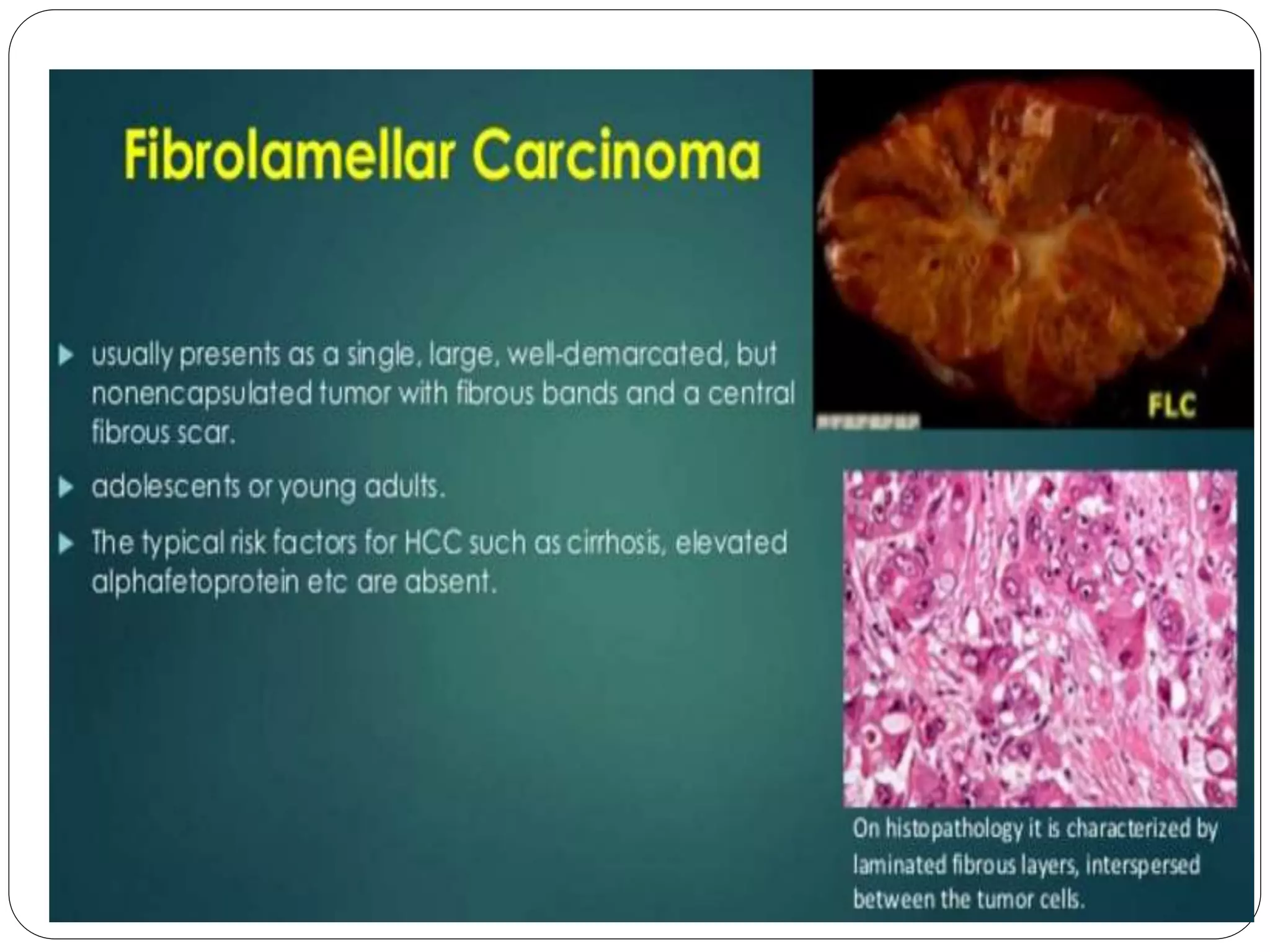 HEPATOCELLULAR CARCINOMA RADIOLOGY | PPTX