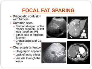 FOCAL FAT SPARING
 Diagnostic confusion
with tumors
 Common sites
 Periportal region of the
medial segment of left
lobe (segment IV)
 Either side of falciform
ligament
 Cranial aspect of GB
fossa
 Characteristic features:
 Geographic appearance
 Lack of mass effect
 Vessels through the
lesion
 