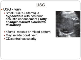 USG
 USG - vary
 Small HCC’s (<3cms) ->
hypoechoic with posterior
acoustic enhancement ( fatty
change/ marked sinusoidal
dilatation)
 >3cms- mosaic or mixed pattern
 May invade poratl vein
 CD:central vascularity
 