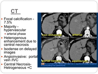 CT
 Focal calcification -
7.5%
 Majority -
hypervascular
 arterial phase
 Heterogenous
enhancement due to
central necrosis
 Isodense on delayed
images
 Angioinvasive: portal
vein /IVC
 Central Necrosis-
Hetrogeneous +C
 