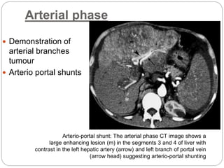 Arterial phase
 Demonstration of
arterial branches
tumour
 Arterio portal shunts
Arterio-portal shunt: The arterial phase CT image shows a
large enhancing lesion (m) in the segments 3 and 4 of liver with
contrast in the left hepatic artery (arrow) and left branch of portal vein
(arrow head) suggesting arterio-portal shunting
 