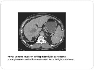 Portal venous invasion by hepatocellular carcinoma.
portal phase-expanded low attenuation focus in right portal vein.
 