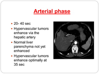Arterial phase
 20- 40 sec
 Hypervascular tumors
enhance via the
hepatic artery
 Normal liver
parenchyma not yet
enhanced
 Hypervascular tumors
enhance optimally at
35 sec
 