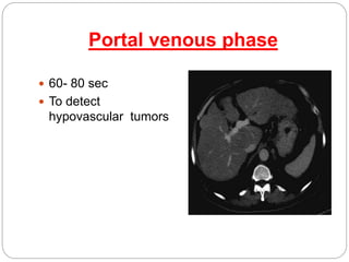 Portal venous phase
 60- 80 sec
 To detect
hypovascular tumors
 