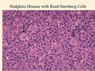 Hodgkins Disease with Reed-Sternberg Cells 
