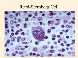 Reed-Sternberg Cell 