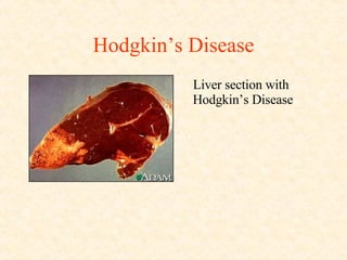 Hodgkin’s Disease Liver section with Hodgkin’s Disease 