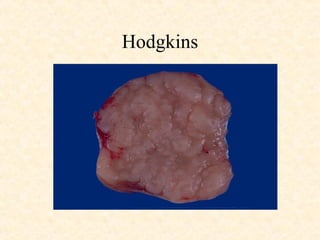 Hodgkins 
